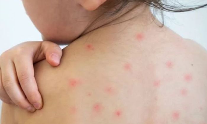 El Ministerio de salud de la Nación confirmó un caso de sarampión en nuestro país